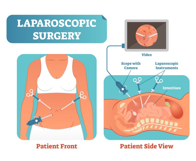 Laparoscopic Surgery Diagram